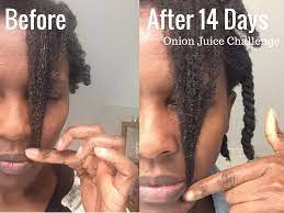 onion juice hair growth challenge results