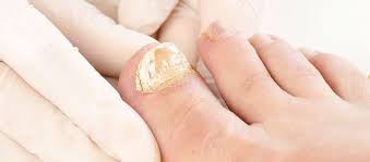 nail fungus treatment edgware nail
