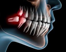causes of wisdom teeth pain dental