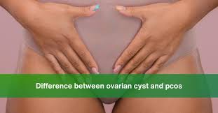 difference between ovarian cyst and