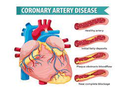 coronary artery disease what s new in