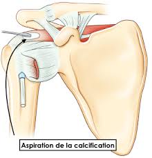 You might have a sudden, sharp and severe pain in the back of your leg and hear a snapping or popping sound when it happens. Les Tendinopathies Calcifiantes De L Epaule Specialiste De La Chirurgie De L Epaule Chirurgie Du Genou A Paris
