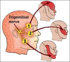 trigeminal neuralgia ayurvedic
