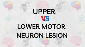 upper vs lower motor neuron lesions