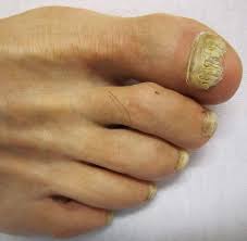 toenail fungus treatment and
