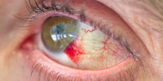 what is a subconjunctival hemorrhage