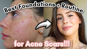 covering acne scars and cystic acne
