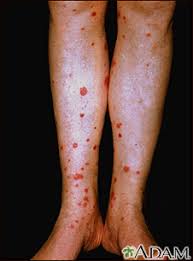 The term purpura is usually used to refer to a skin rash in which small spots of blood appear on the skin. Purpura Information Mount Sinai New York