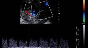 doppler ultrasound scans in pregnancy