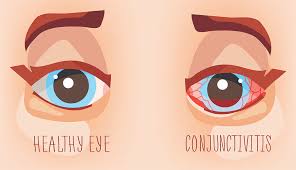 pink eye what are the symptoms and how