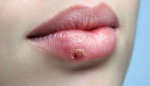 cold sore could spread virus