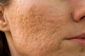 microdermabrasion for acne scarring
