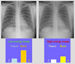 dual energy radiography acquisition and