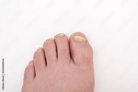 fungal infection of the nail mycosis
