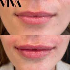 10 ways to make lip fillers last longer