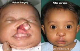 cleft lip and cleft palate surgery
