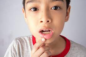 what is a canker sore does my child