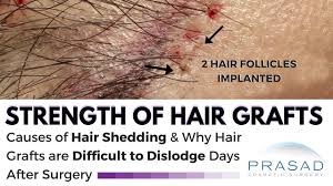 post hair transplant grafts are too