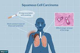 squamous cell carcinoma in the lungs