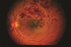 Image result for icd 10 code for brvo right eye