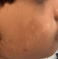 white spots on cheek