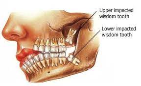 causes of wisdom teeth pain and why