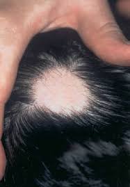 patchy alopecia areata at the left