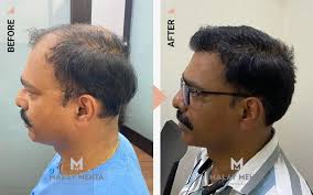 fue hair transplant mumbai m
