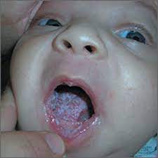 white coating on infant s tongue