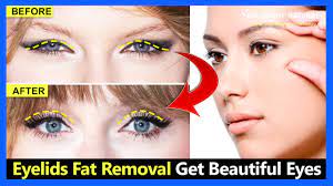 eyelids fat removal exercises get