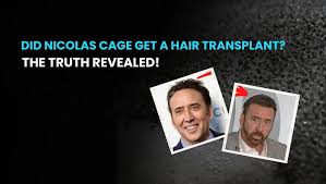 nicolas cage s hair transplant