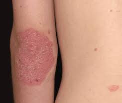 From red and scaly to white and blistering, psoriasis skin rashes come in several different forms. Psoriasis Skin Disorders Merck Manuals Consumer Version
