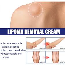 lipoma removal cream herbal extract