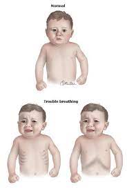 Rashes caused by an antibiotic allergy may last 3 to 14 days, whereas diaper rash almost always clears up within 1 week (if diapers are changed frequently). Bronchiolitis And Rsv After Hours Kids Physician Assistants