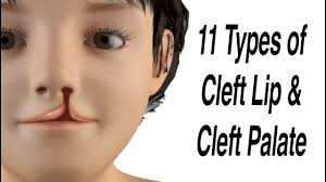 11 types of cleft lip and cleft palate