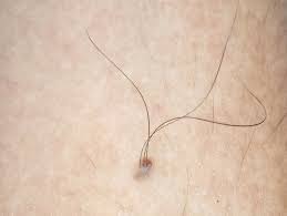 skin moles that grow hair may offer