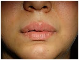 granulomatous cheilitis or rculid