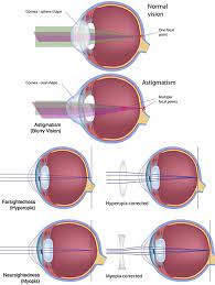 types of lasik eye surgery top rated