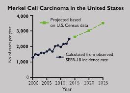 Steep U S Increase Projected For Rare Skin Cancer Newsroom