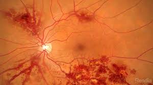 retinal venous occlusive disease eye