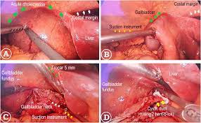 laparoscopic cholecystectomy for the