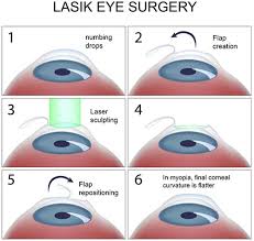 I'm arielle, and i recently got lasik eye surgery. Lasik Eye Surgery Top Eye Specialist Best Rated Nyc Ophthalmologist