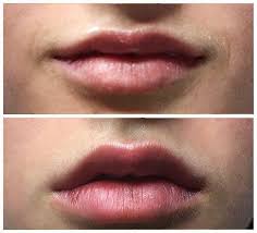 lip injections white rock lip fillers