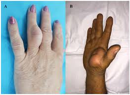 lipoma on the hand and fingers