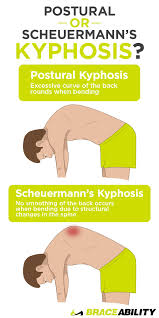 Scheuermann's disease, kyphosis, & kyphoscoliosis has 3,581 members. Pin On Back Injuries Spine Disorders What S Causing My Back Pain Lower Middle Upper Back Problems