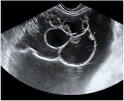 When this process begins, there may be no or only vague symptoms. The Characteristic Ultrasound Features Of Specific Types Of Ovarian Pathology Review Ultrasound Ultrasound Sonography Medical Ultrasound