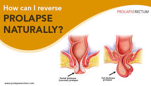 how can i reverse prolapse naturally