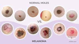 The skin on the surface may break down and look scraped. Melanoma Pictures Skin Melanomas Vs Non Cancerous Moles