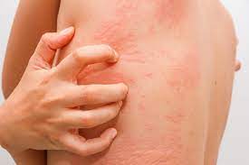 hives rash skin rash itchy skin