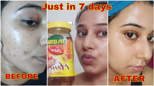 7 days challenge remove pimple marks